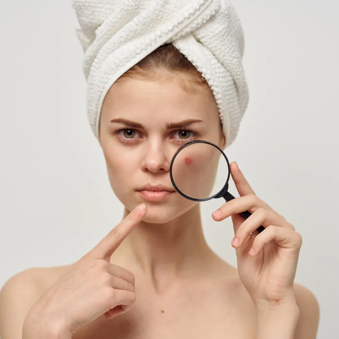 Reduces Oiliness & Acne